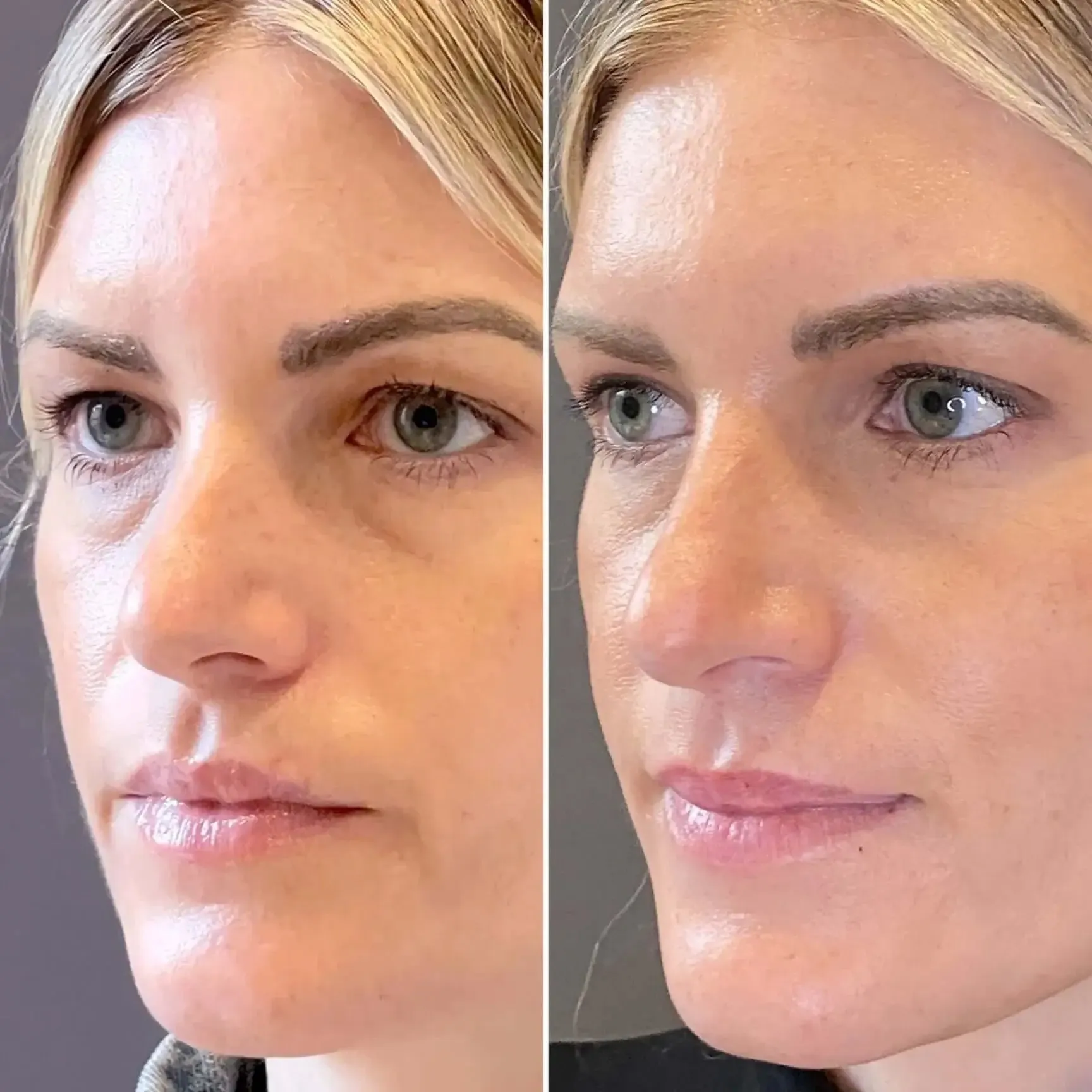 EyeFix: Upper Blepharoplasty