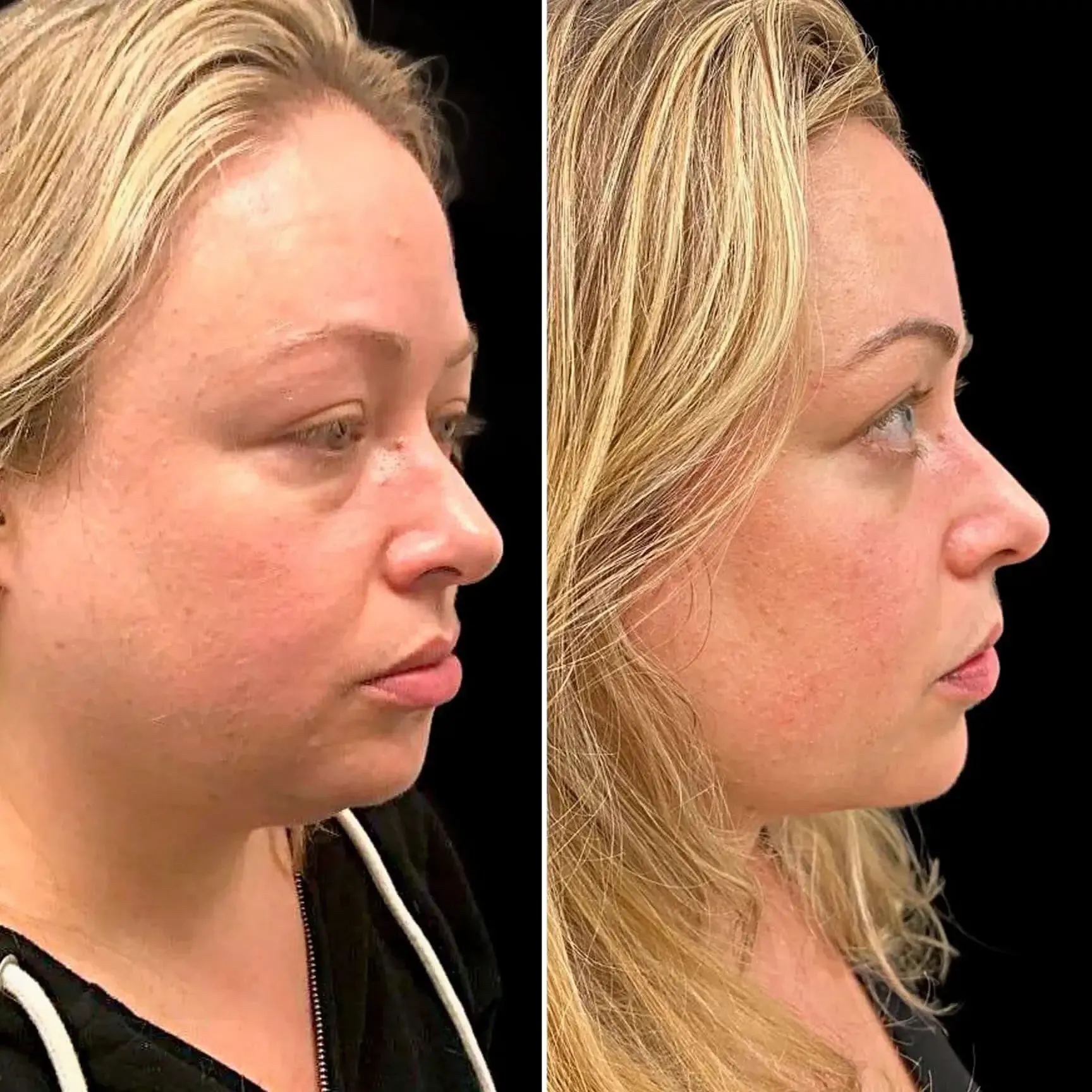 EyeFix: Upper Blepharoplasty