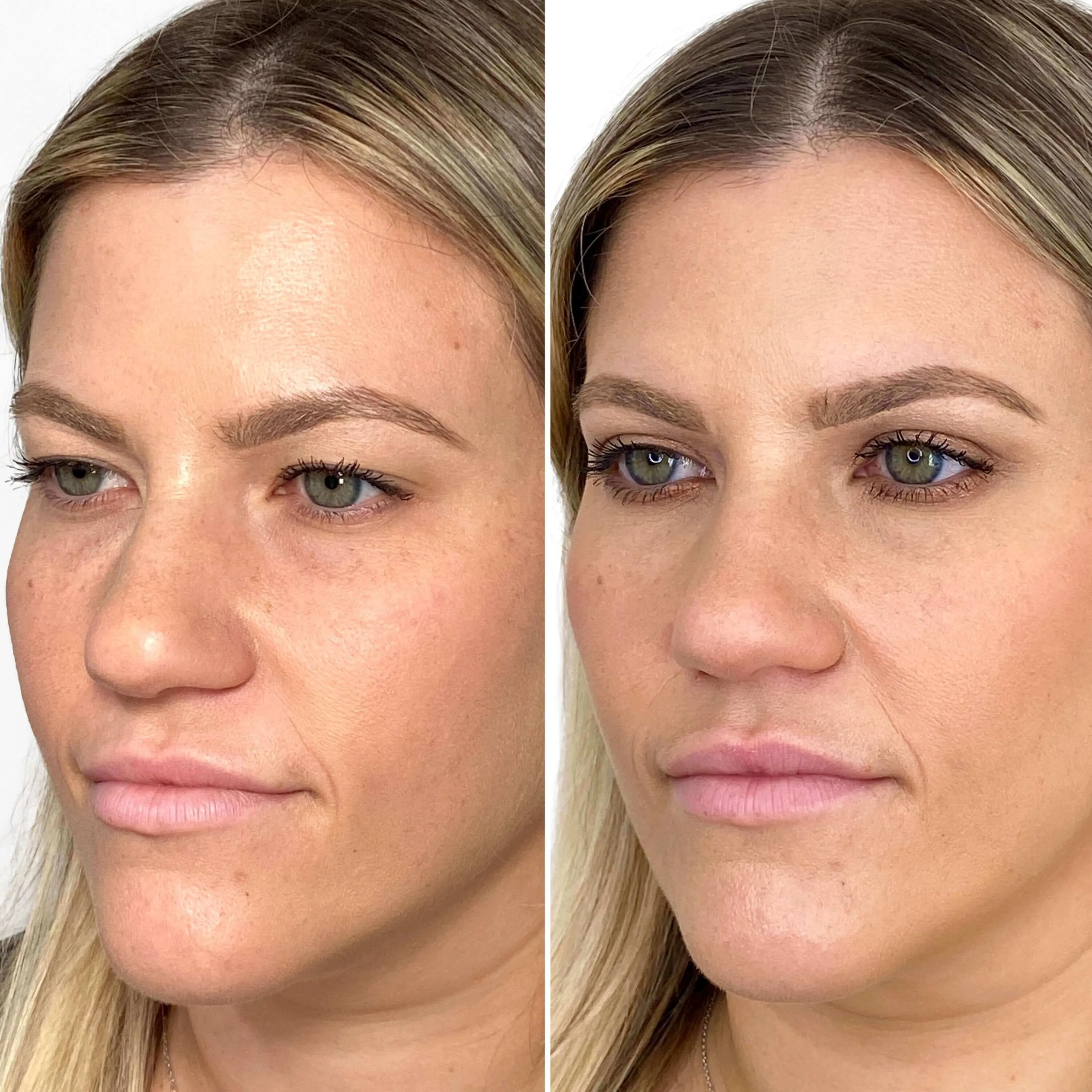 EyeFix: Upper Blepharoplasty